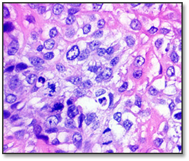 Osteosarcoma histology